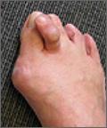 Advanced bunion and hammer toe